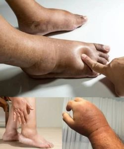 Swollen Hands and Feet: Simple Foods That May Support Natural Balance