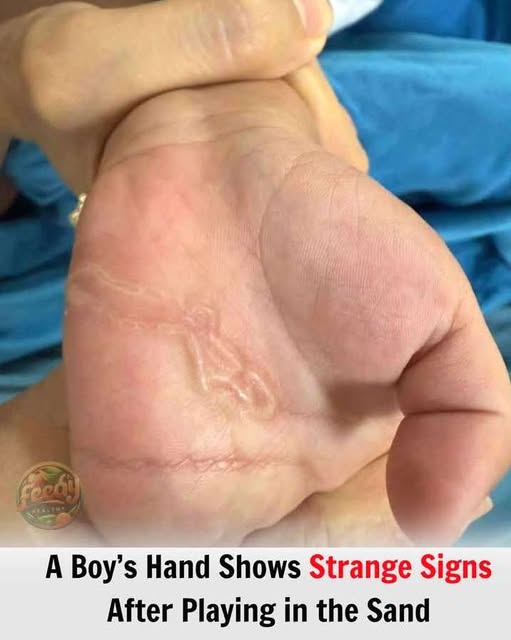 A Boy’s Hand Shows Strange Signs After Playing in the Sand